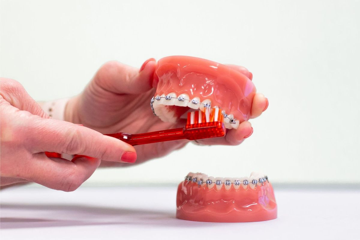 Tips for Brushing with Braces